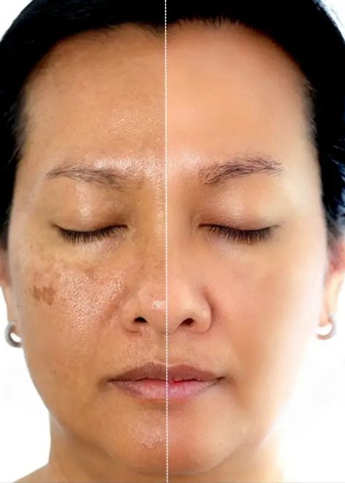 Tratamento-para-melasma